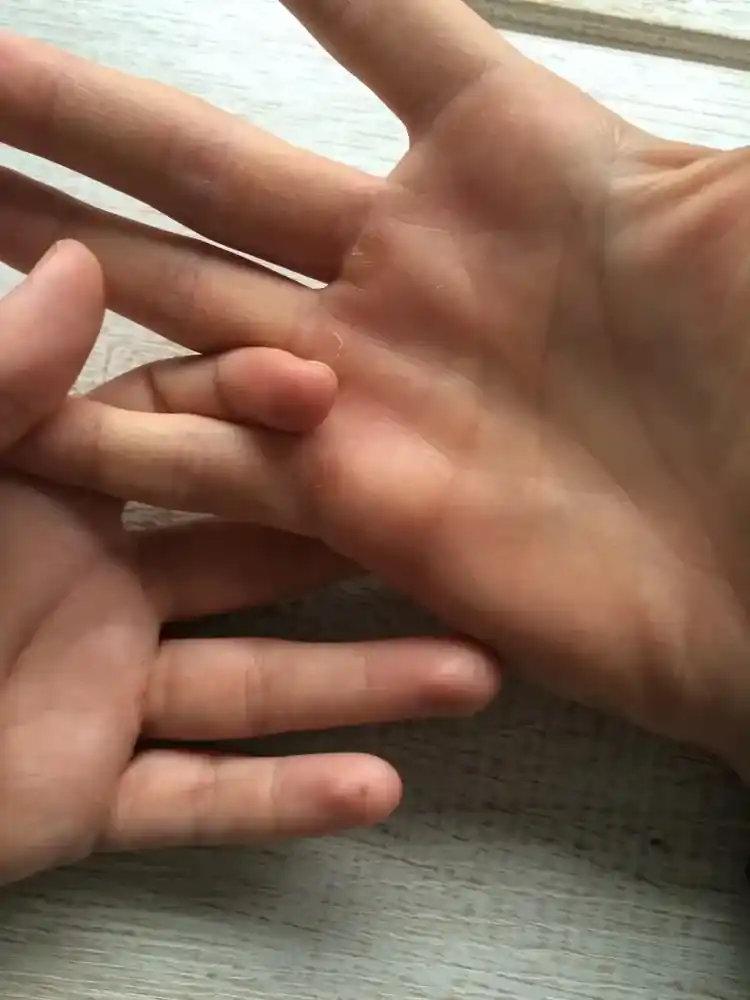 Hornhaut an der Hand
